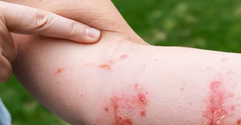 Skip These 5 Poison Ivy Treatments – Try These 9 Vinegar Solutions Instead