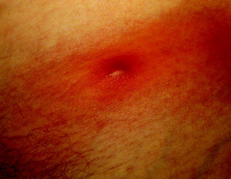 A dark or worsening sore does not prove a spider bite A dark or worsening sore does not prove a spider bite