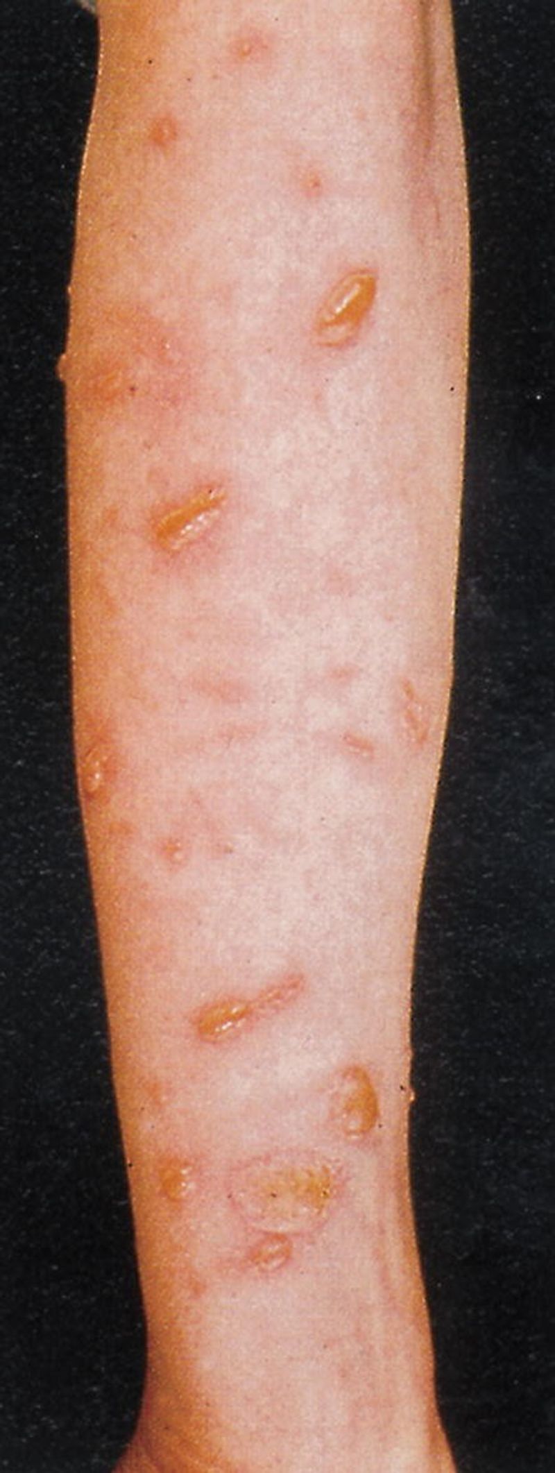 “Burns skin” hides several different kinds of plant injury