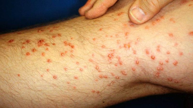 A sting becomes an emergency when the reaction spreads beyond the skin