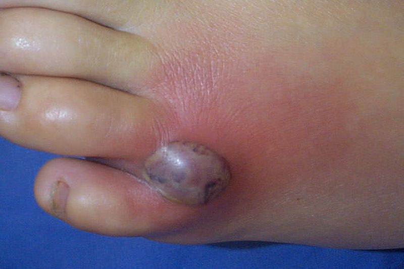 Judge a suspected bite by symptoms, not by assumption