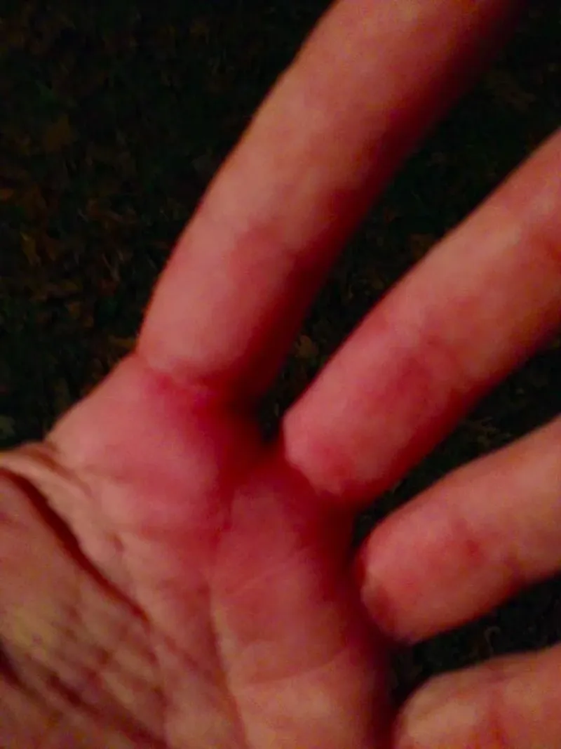 Know when a sting needs urgent medical care