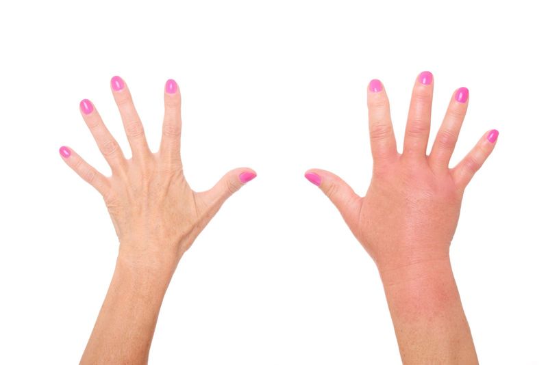 What to Do After a Sting—and When to Call 911