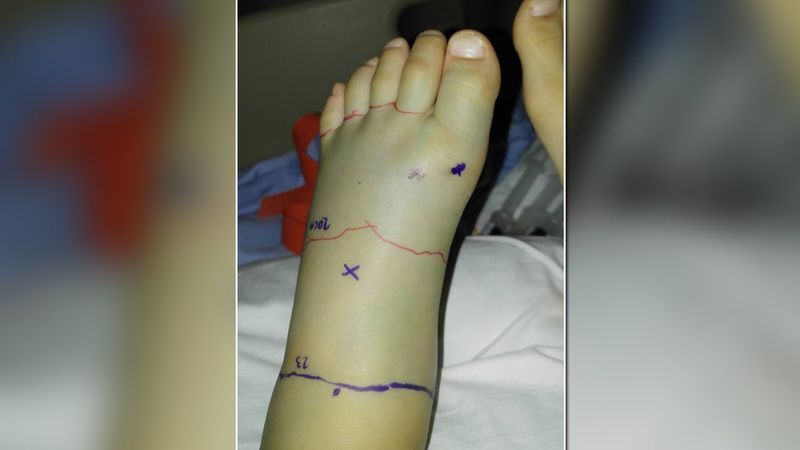 A possible venomous bite is an emergency