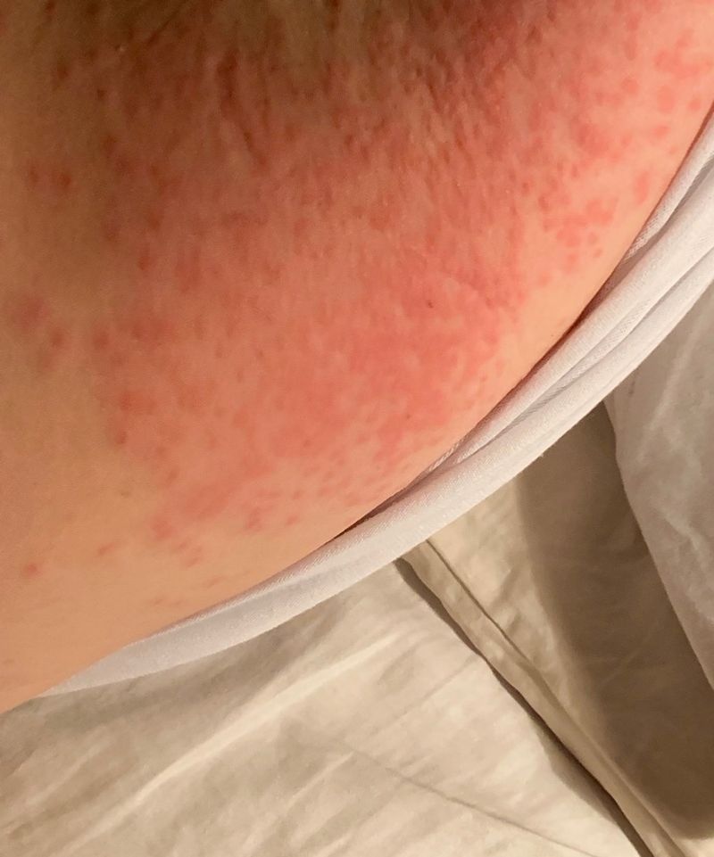 After skin contact, lift hairs with tape and wash